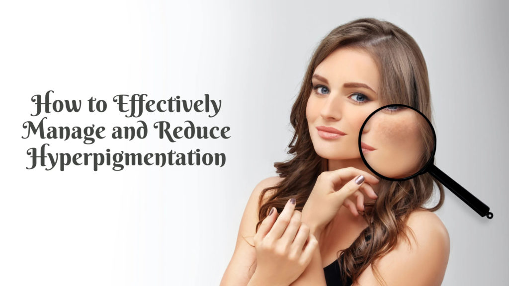 Effective Strategies to Tackle Hyperpigmentation