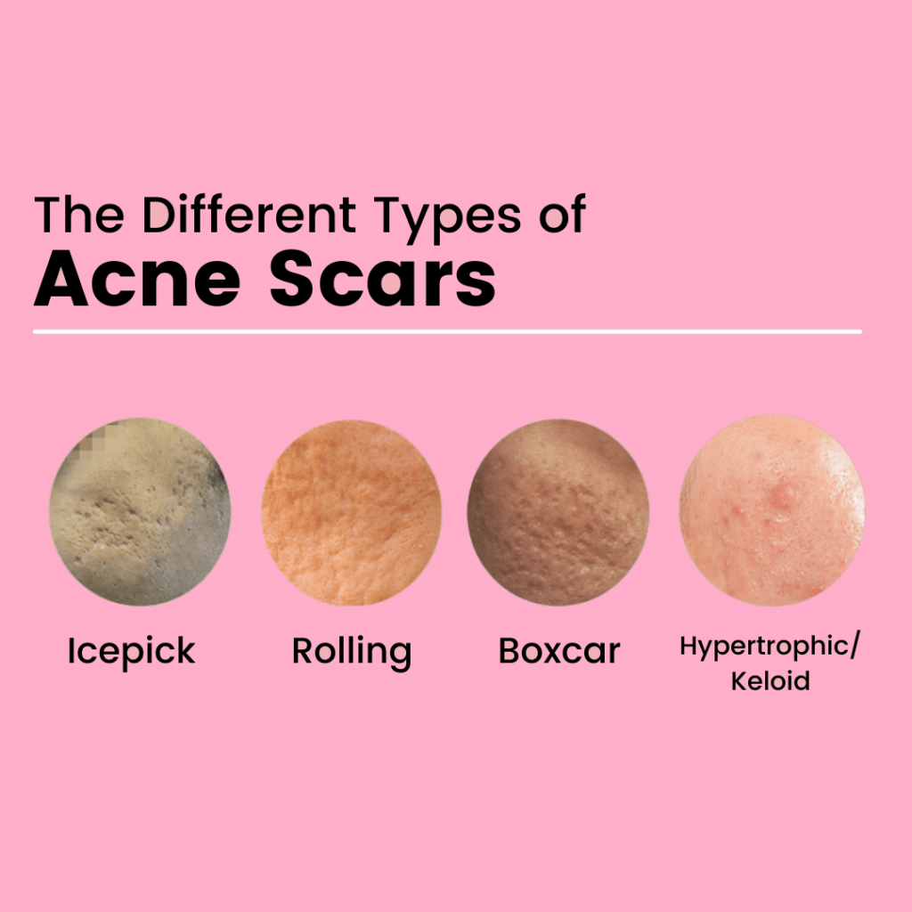 Understanding Different Types of Acne Scars