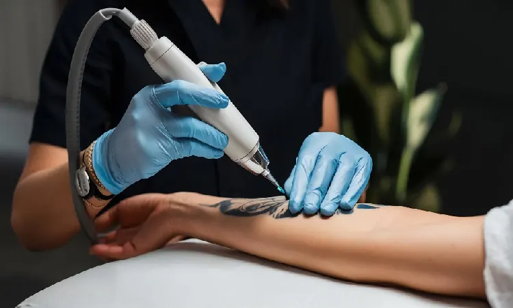 Laser Tattoo Removal